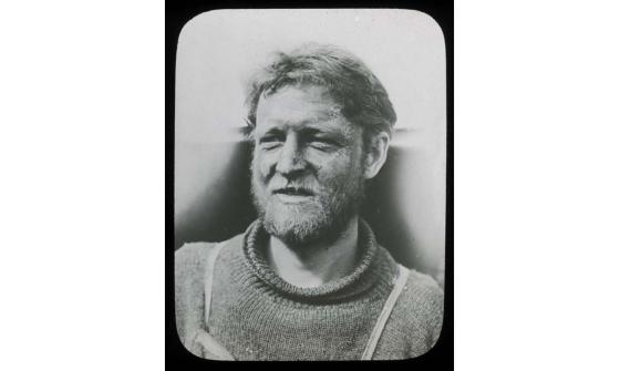 A black and white photo of a man with a frostbitten face.