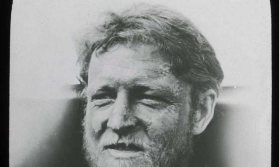 A black and white photo of a man with a frostbitten face.