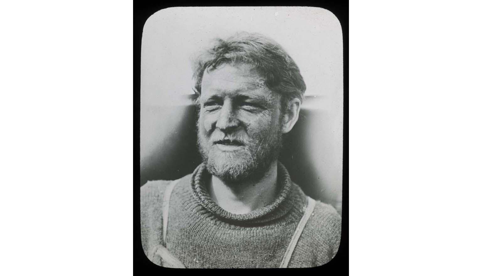 A black and white photo of a man with a frostbitten face.