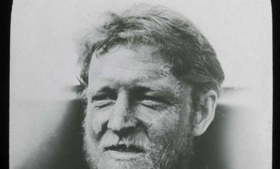 A black and white photo of a man with a frostbitten face.